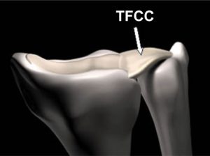 Lesione cartilagine triangolare TFCC