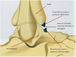 sindrome inpingment caviglia
