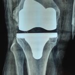 artroprotesi ginocchio post operatorio