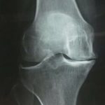artroprotesi ginocchio pre operatorio