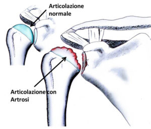 artrosi spalla