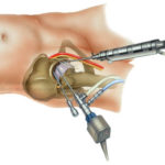 procedura artroscopica anca