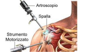 procedura artroscopica spalla
