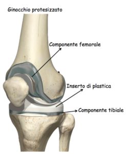 protesi ginocchio 2